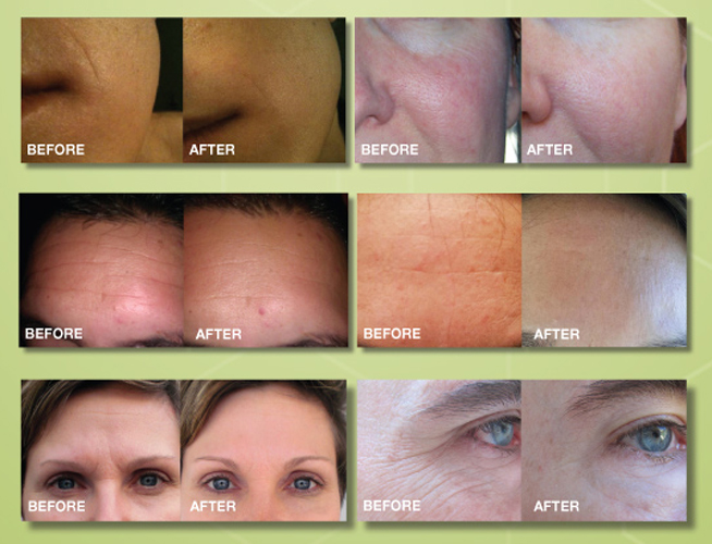 NeriumAD Before and After Picture